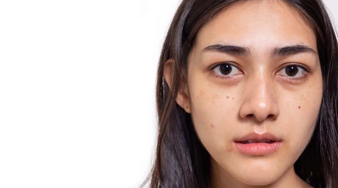 contoh penyebab flek hitam di wajah akibat sinar matahari