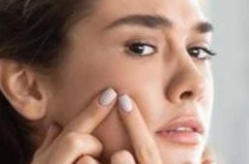 Kenali Tipe Jerawat untuk Perawatan yang Tepat