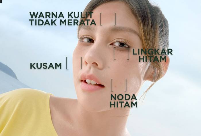 Macam-macam Hiperpigmentasi Kulit Pada Wajah