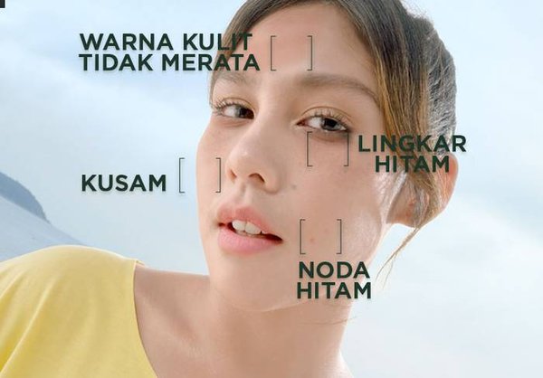 Macam-macam Hiperpigmentasi Kulit Pada Wajah