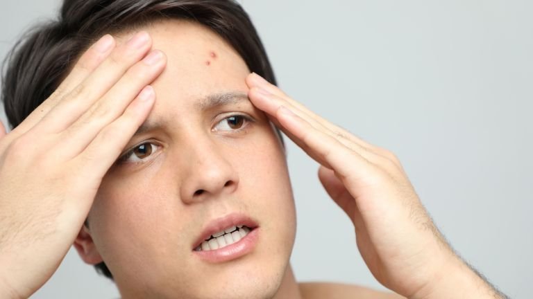 Panduan Aman Menggunakan Salicylic Acid untuk Jerawat