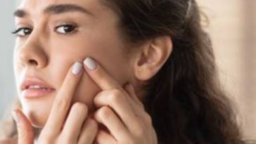 Penyebab Jerawat Batu di Pipi