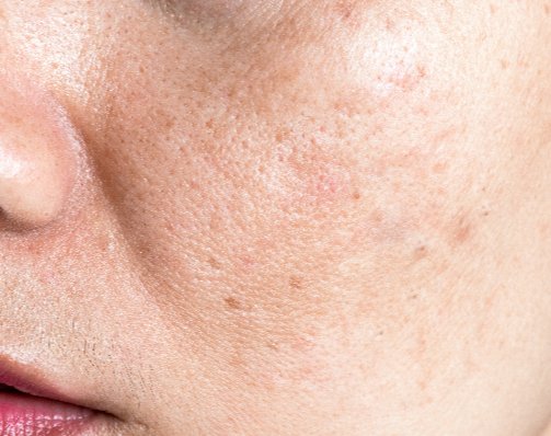 Tanda-Tanda Kulit Wajahmu Butuh Eksfoliasi