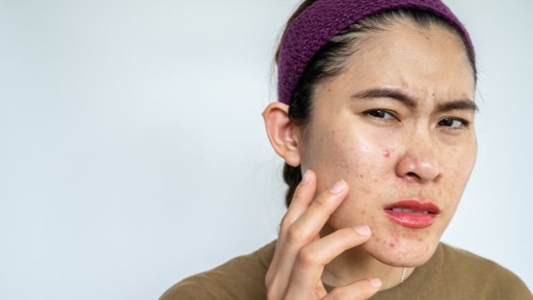 Yuk, Kenalan dengan Berbagai Jenis Jerawat dan Cara Mengatasinya