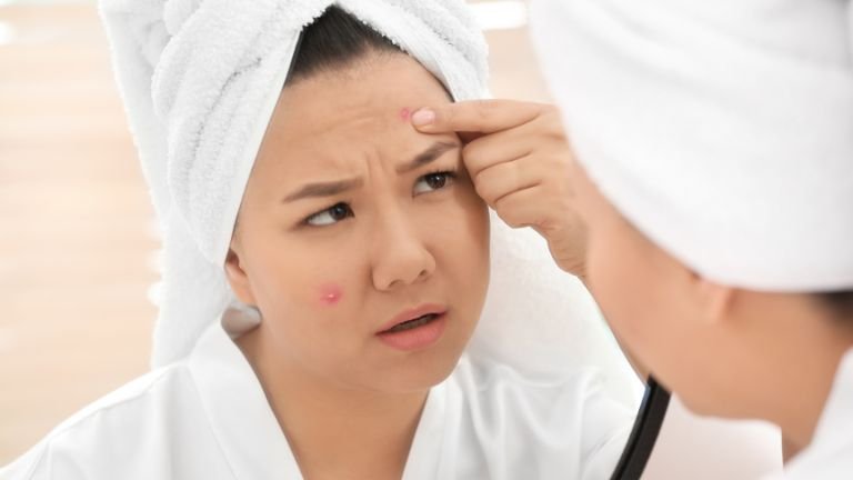 Rekomendasi Skincare untuk Menghilangkan Jerawat dan Bekasnya untuk Remaja