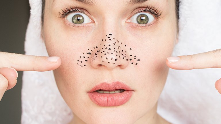 Mudah Ini 15 Cara Menghilangkan Komedo Secara Alami