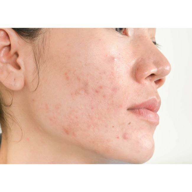 101 Hal yang Perlu Diketahui Soal Melasma Pada Kulit