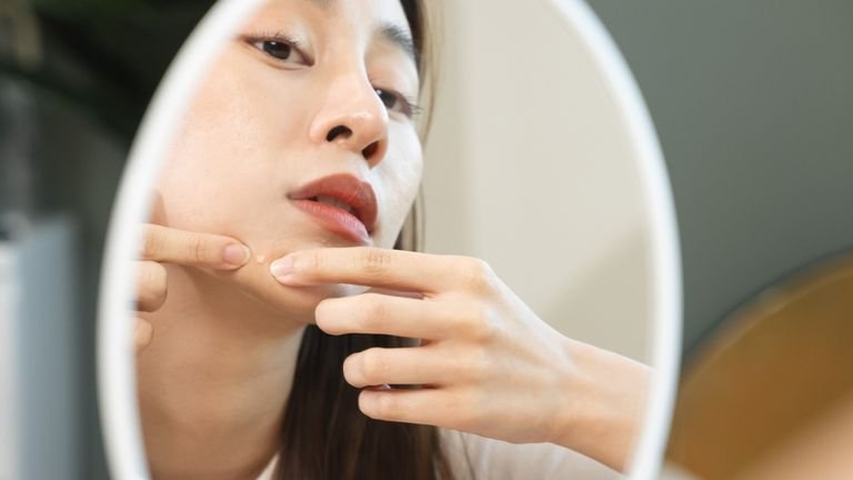 Penyebab Jerawat di Dagu