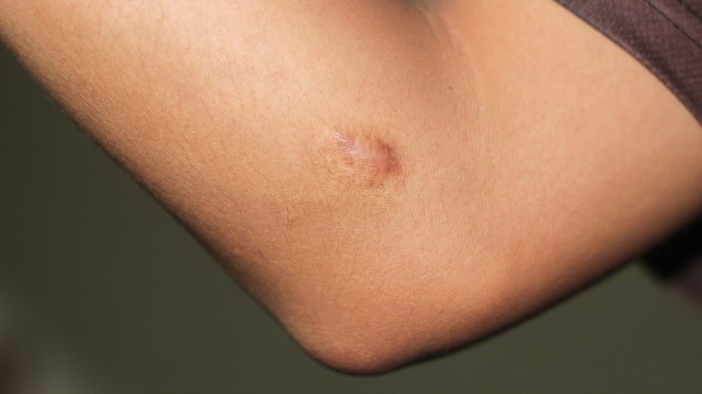 Keloid: Penyebab, Ciri-Ciri, dan Cara Menghilangkannya