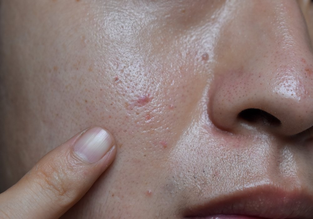 Apa Itu Sebum Wajah dan Bagaimana Cara Menguranginya?