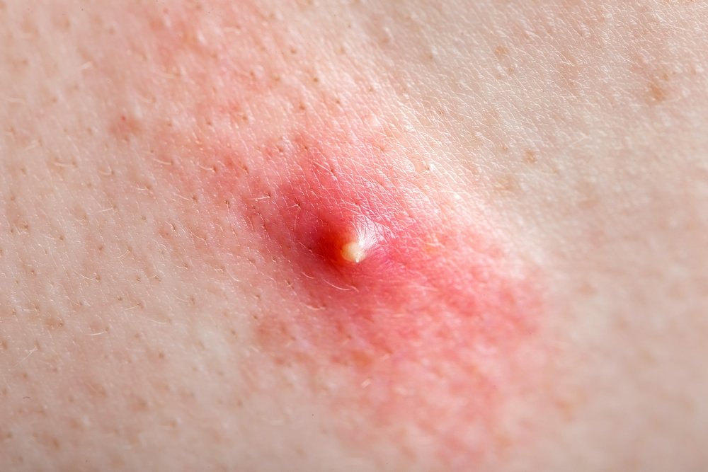 Jerawat Hormon: Ciri-Ciri, Penyebab, dan Cara Mengatasi