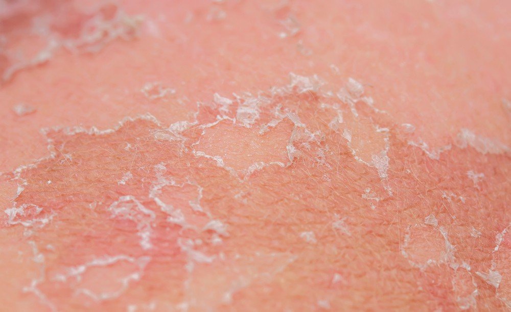 cara-menghilangkan-sel-kulit-mati-yang-tidak-membuat-wajah-kering