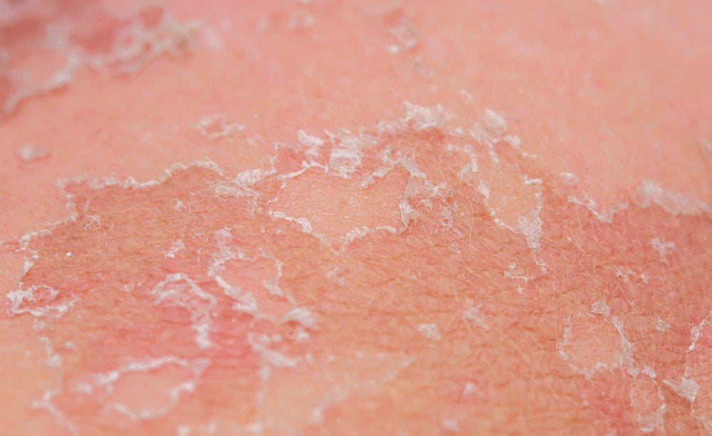 cara-menghilangkan-sel-kulit-mati-yang-tidak-membuat-wajah-kering