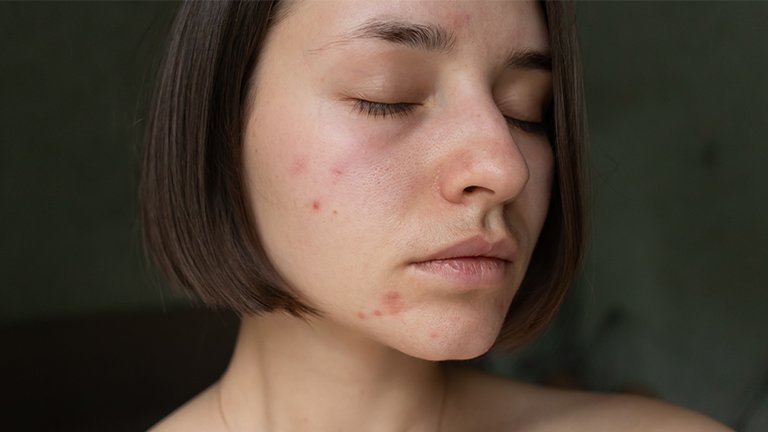 12 Cara Menghilangkan Jerawat Secara Alami dan Cepat