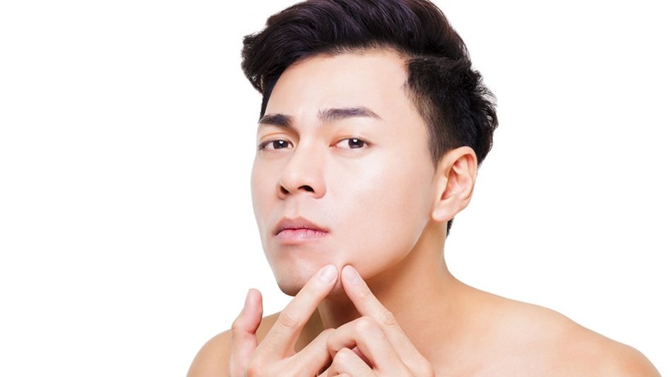 penyebab munculnya jerawat