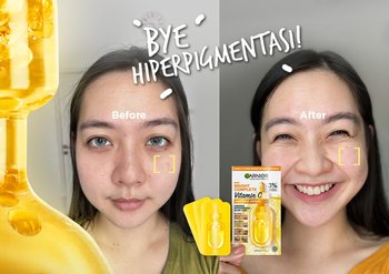 hyperpigmentationRating_4