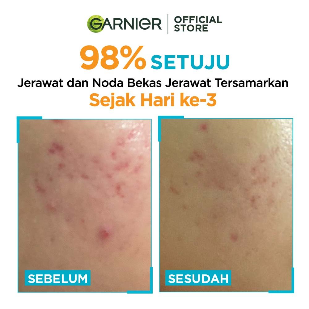 bright_complete_anti_acne_serum_T4